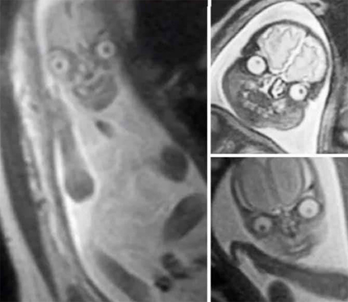 La razón por la que a las mujeres embarazadas les hacen ecografías con ultrasonidos y no resonancias magnéticas, es porque con las resonancias el feto se ve así: